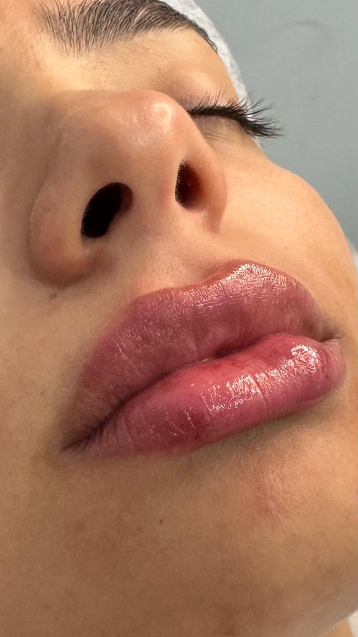 Preenchimento Labial
