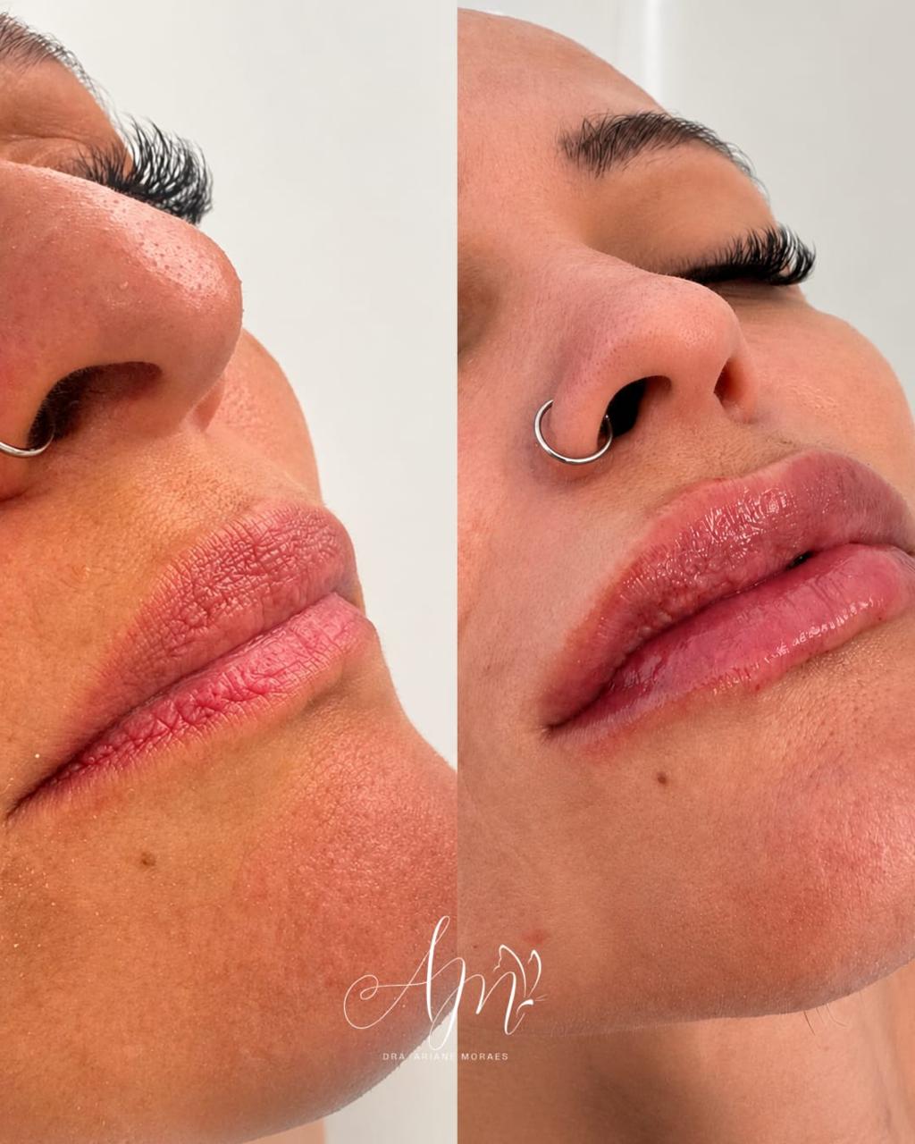 Antes e depois